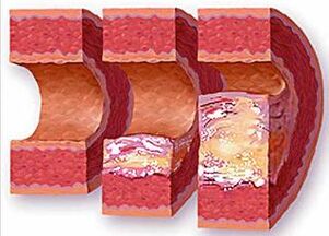 Stages of development of atherosclerotic plaque in a hypertensive vessel